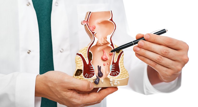 Hämorrhoiden - OA. Dr. Zacaria Sow - Allgemeinchirurg/Viszeralchirurg Wien 1210