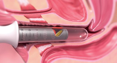 Inkontinenzbehandlung mit Laserlicht