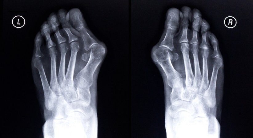 Fußchirurgie - Dr. med. univ. Clemens Carl Wissiak - Orthopäde Deutschlandsberg 8530