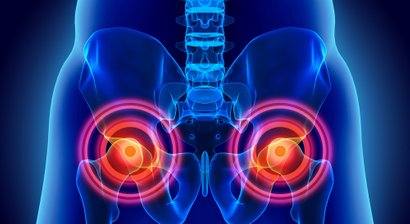Hüfttotalendoprothese