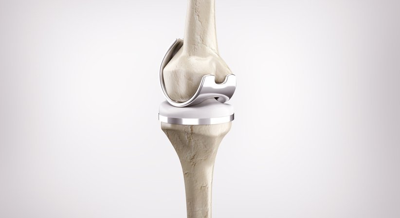 Knieoperationen - Dr. med. univ. Clemens Carl Wissiak - Orthopäde Deutschlandsberg 8530