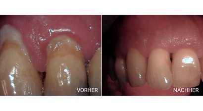 Parodontosetherapie und Orthomolekularen Medizin