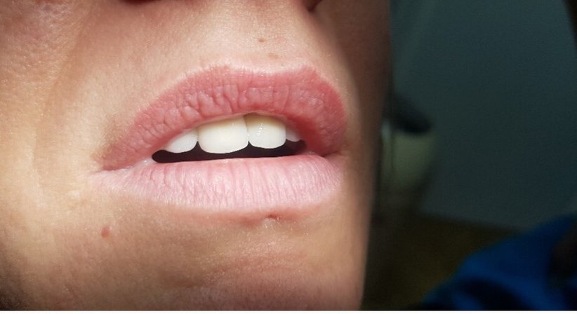 Mikroinvasive kosmetische Zahnheilkunde: Zirkonkronen und Veneers - Dr. Stefan C. Wilson - Zahnarzt Linz 4020
