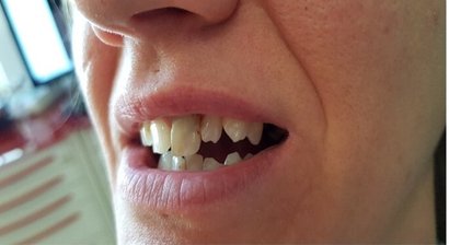 Mikroinvasive kosmetische Zahnheilkunde: Zirkonkronen und Veneers