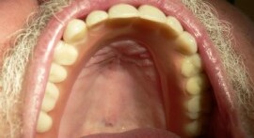 Teleskopprothese - Dr. Stefan C. Wilson - Zahnarzt Linz 4020