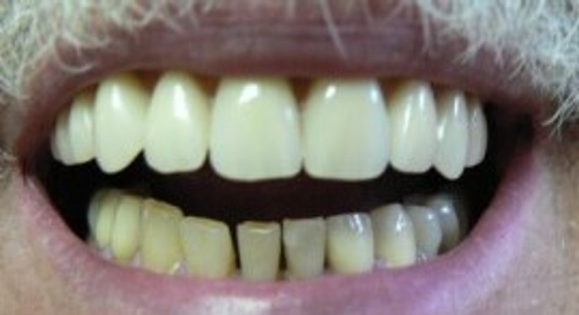 Teleskopprothese - Dr. Stefan C. Wilson - Zahnarzt Linz 4020