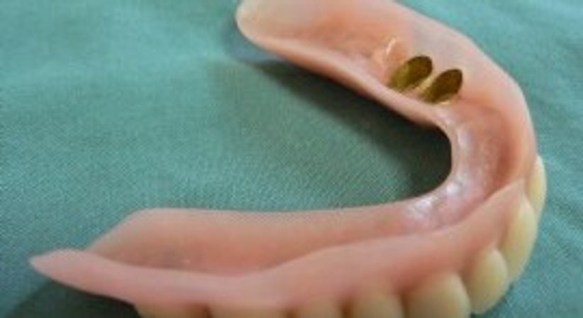 Teleskopprothese - Dr. Stefan C. Wilson - Zahnarzt Linz 4020