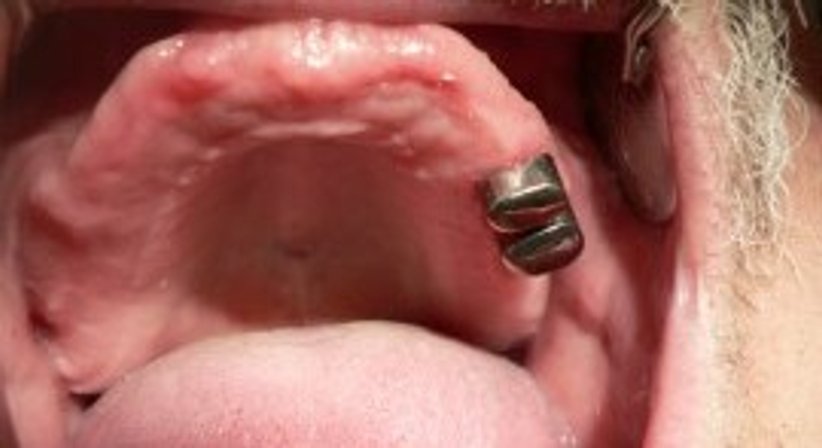 Teleskopprothese - Dr. Stefan C. Wilson - Zahnarzt Linz 4020