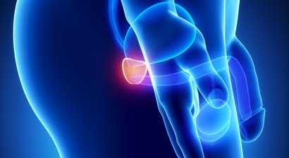 Prostatavergrößerung