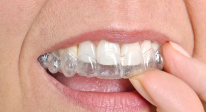 Unsichtbare Zahnspange