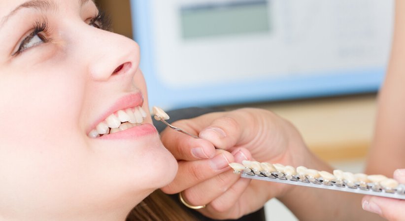 Veneers - Dr. med. dent. Mathias Steyrer - Zahnarzt Wien 1120