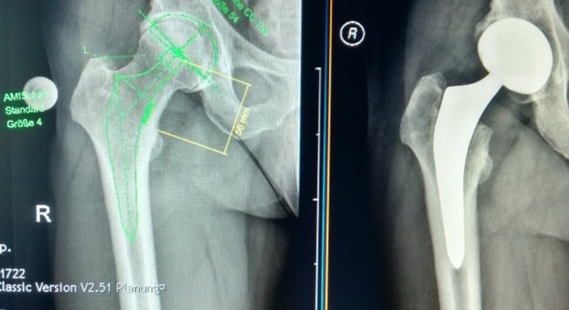 Coxarthrose / künstlicher Hüftgelenksersatz - OA Dr. Philipp Grabowiecki - Orthopäde Mödling 2340