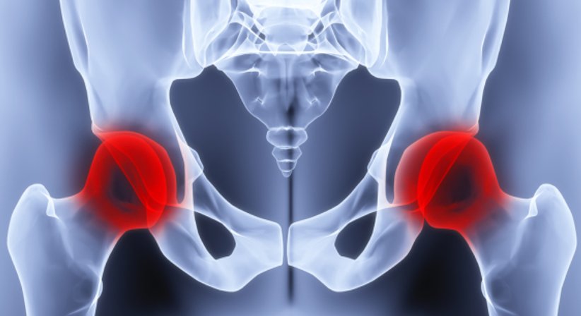 Coxarthrose / künstlicher Hüftgelenksersatz - OA Dr. Philipp Grabowiecki - Orthopäde Mödling 2340