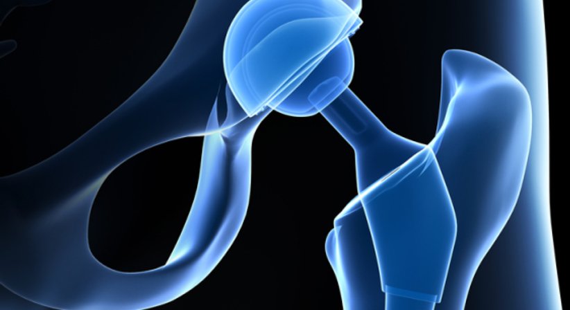 Coxarthrose / künstlicher Hüftgelenksersatz - OA Dr. Philipp Grabowiecki - Orthopäde Mödling 2340