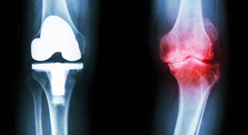 Gonarthrose/Knieprothese - OA Dr. Philipp Grabowiecki - Orthopäde Mödling 2340