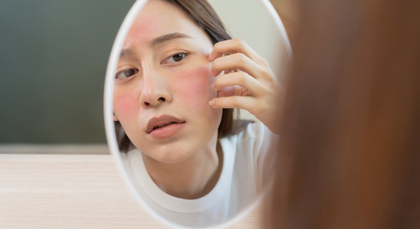 Rosazea - Dr. Sophie Hammerer - Hautärztin Wien 1010