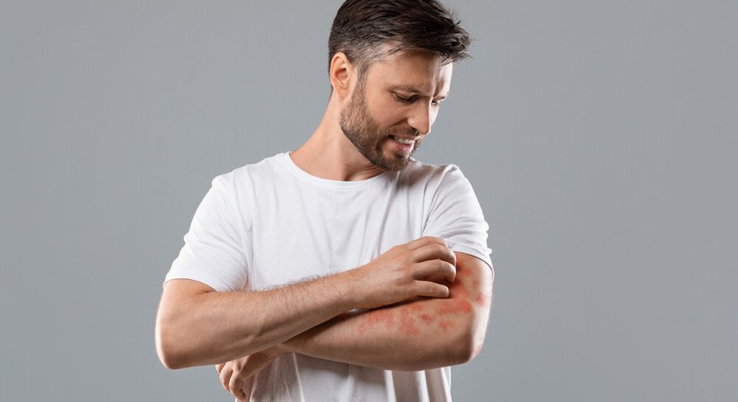 Akuter und chronischer Nesselausschlag (Urtikaria) - Dr. Sophie Hammerer - Hautärztin Wien 1010