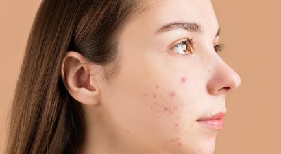 Akne vulgaris, Akne inversa