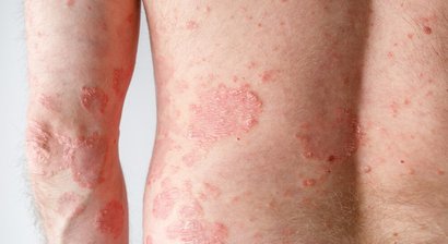 Psoriasis (Schuppenflechte)