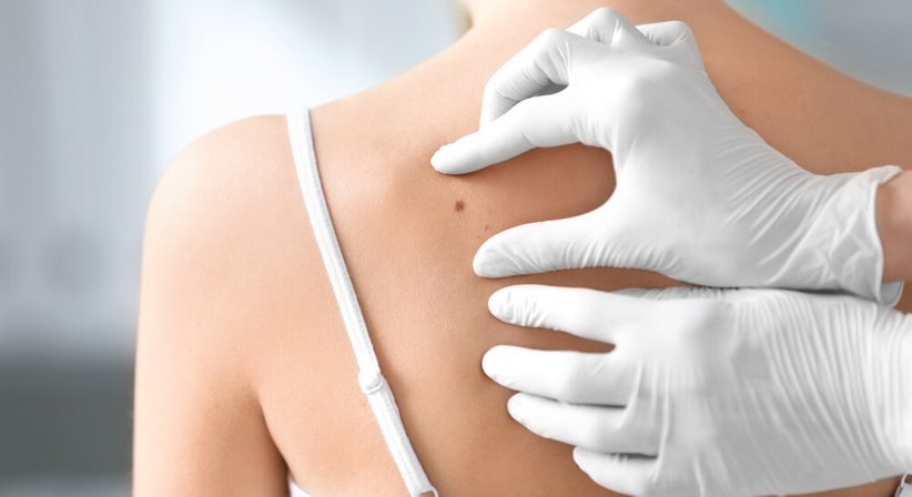 Kryotherapie (Vereisung) - Dr. Sophie Hammerer - Hautärztin Wien 1010