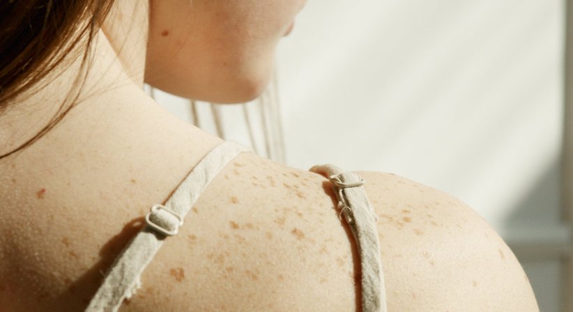 Muttermalkontrolle und Hautkrebsvorsorge - Dr. Sophie Hammerer - Hautärztin Wien 1010