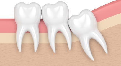 Oralchirurgische Eingriffe