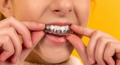 Unsichtbare Zahnspange (Alignertherapie)