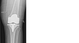 ​Knieprothese -