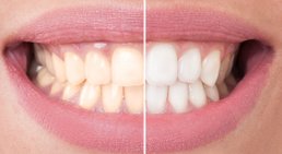 Bleaching -