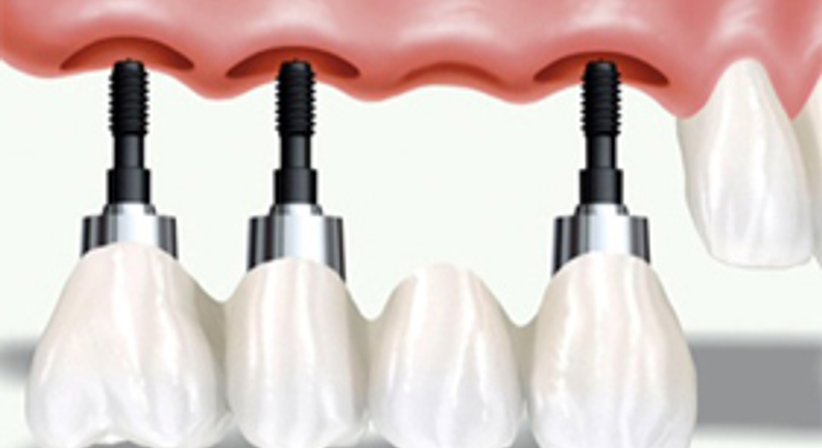 Implantate - DDr. Vesna Stephan - Zahnärztin Wien 1170