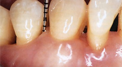 Parodontitis Behandlung