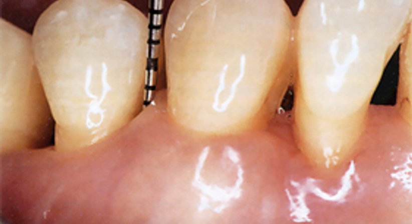 Parodontitis Behandlung - DDr. Vesna Stephan - Zahnärztin Wien 1170