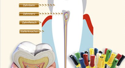Wurzelkanalbehandlung