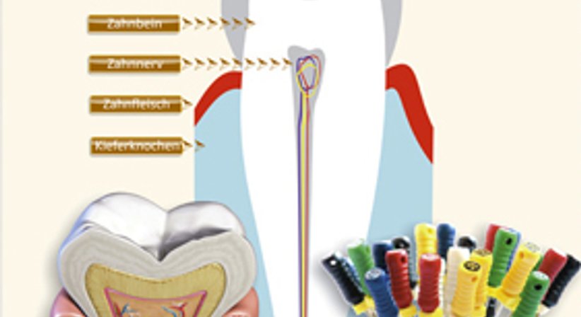 Wurzelkanalbehandlung - DDr. Vesna Stephan - Zahnärztin Wien 1170