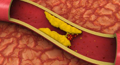 Ultraschall der Becken-Beingefäße (Sonografie der peripheren Gefäße)