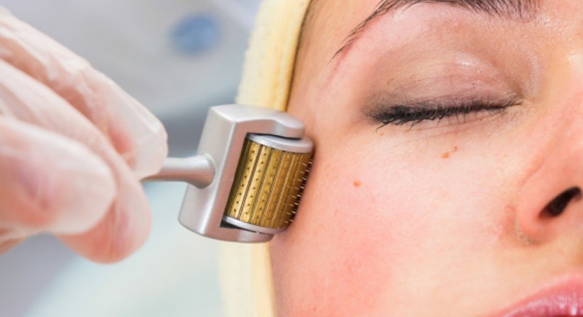 Microneedling/Medical Needling - Priv.-Doz. Dr. Silvia Wessely - Hautärztin Wien 1170