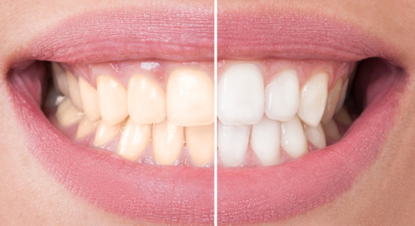 Bleaching - Dr. med. dent. Rene M. Filipowitsch - Zahnarzt Bregenz 6900