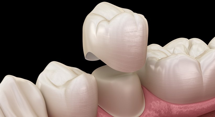 Kronen- und Brückenversorgung - Dr. Theresa Mihalits - Zahnärztin Draßburg 7021