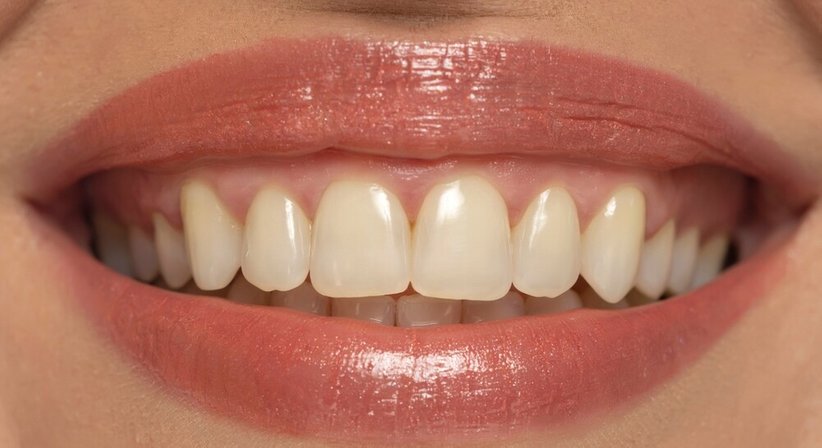 Ästhetische Korrekturen - Dr. Theresa Mihalits - Zahnärztin Draßburg 7021