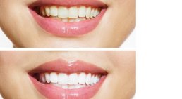 Bleaching -