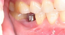 Implantate -