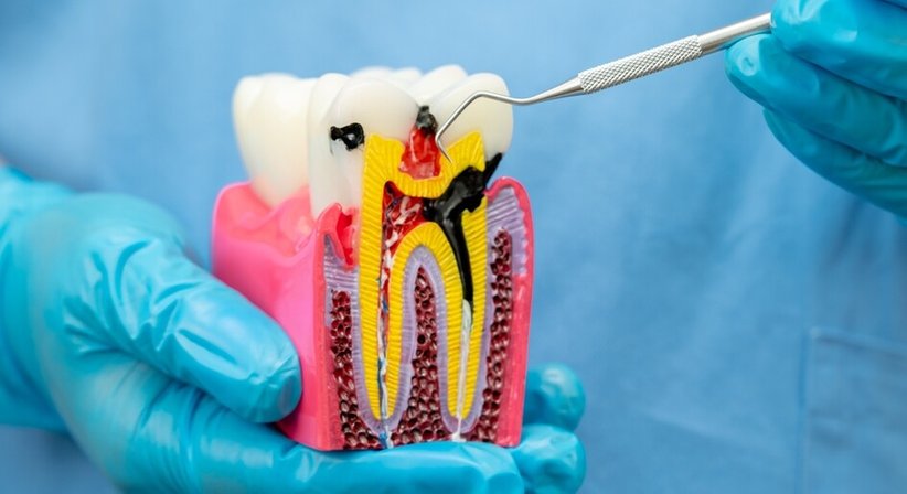 Wurzelbehandlung - DDr. Julia d'Aron, MSc - Zahnärztin Wien 1190