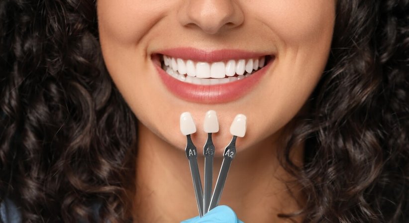 Veneers - DDr. Julia d'Aron, MSc - Zahnärztin Wien 1190