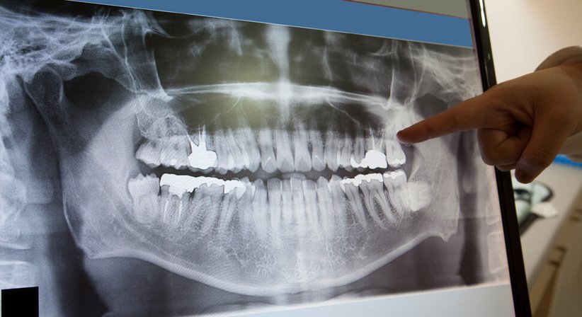 Oralchirurgie - DDr. Julia d'Aron, MSc - Zahnärztin Wien 1190