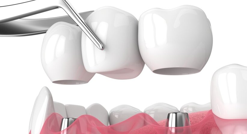 Kronen und Brücken - DDr. Julia d'Aron, MSc - Zahnärztin Wien 1190