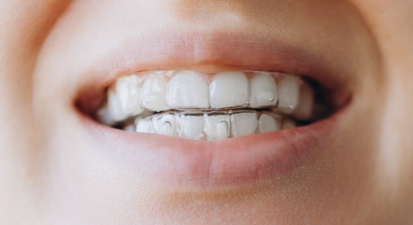 Unsichtbare Zahnspange (Aligner-Therapie) - DDr. Julia d'Aron, MSc - Zahnärztin Wien 1190
