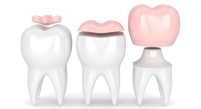 Inlays, Onlays, Overlays - DDr. Julia d'Aron, MSc - Zahnärztin Wien 1190