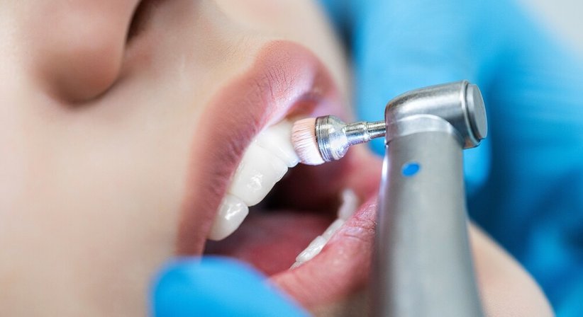 Professionelle Zahnreinigung (Zahnprophylaxe) - DDr. Julia d'Aron, MSc - Zahnärztin Wien 1190