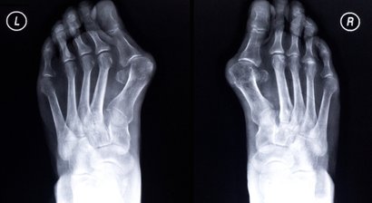 Hallux valgus