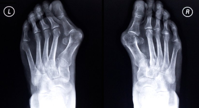 Hallux valgus - OA Dr. Heribert Salfinger - Orthopäde Wien 1180